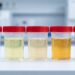 Descubre cómo el color de la orina puede reflejar tu estado de salud y cuándo es necesario consultar al médico.